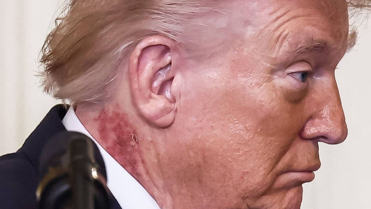 Trump's Health: 'Heart of 65' Amid Skin Rashes and Bruises